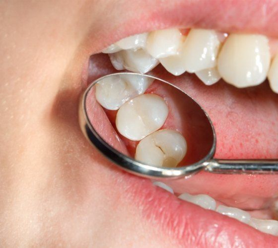 Close up of dental mirror in mouth showing cracked tooth